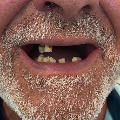 Implante Dentário Antes